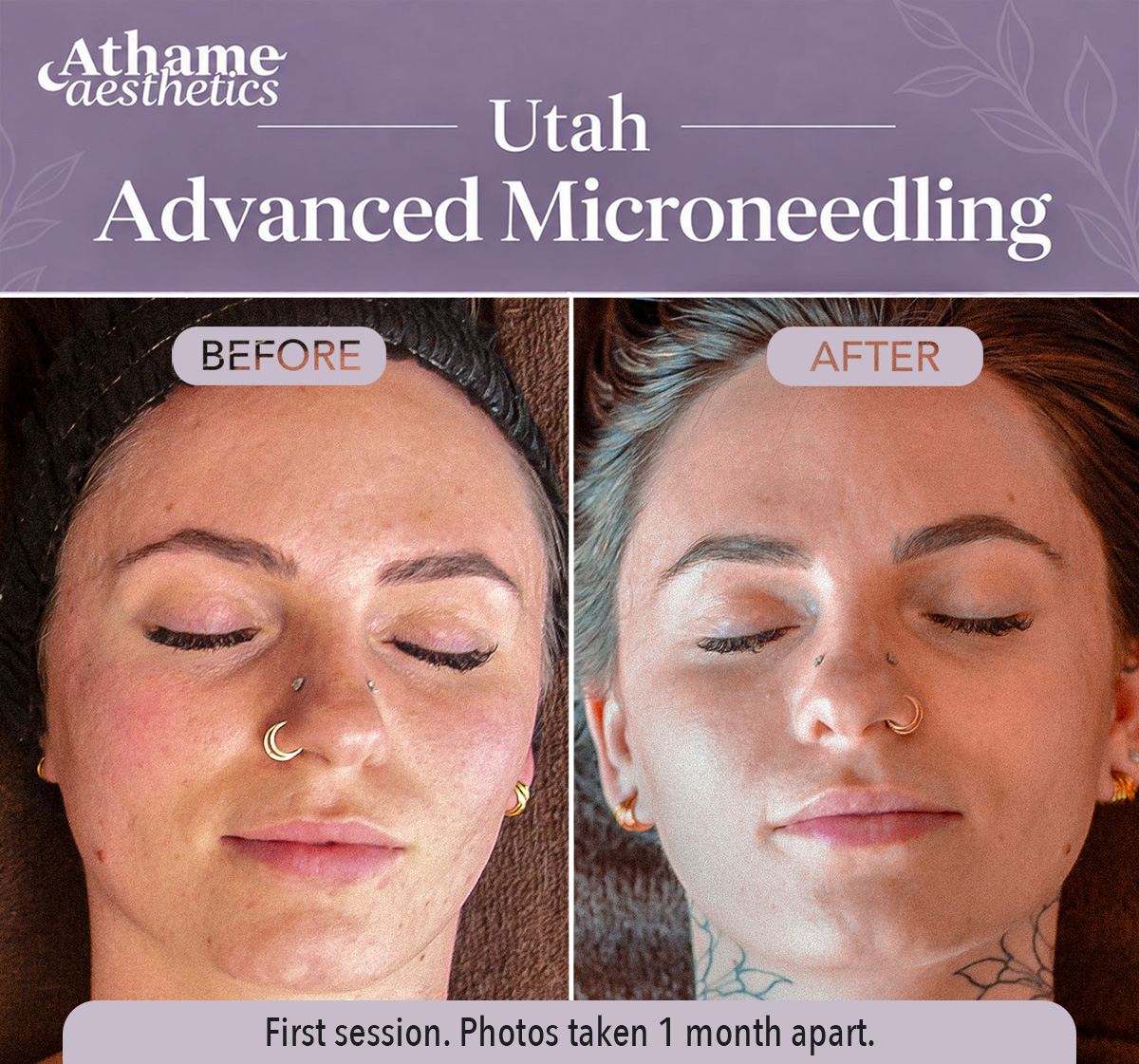 Microneedling before and after photo