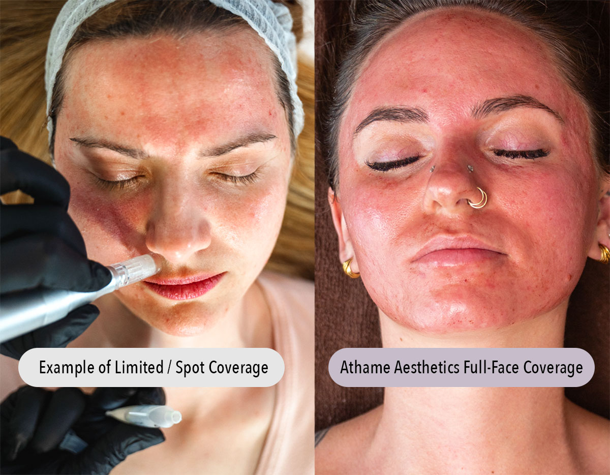 advanced-microneedling-before-after-athame-aesthetics